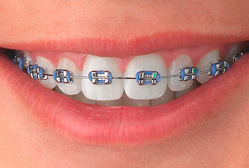 Brackets Metalicos